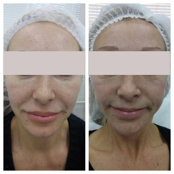 Плазмолифтинг отзывы фото до и после лицо