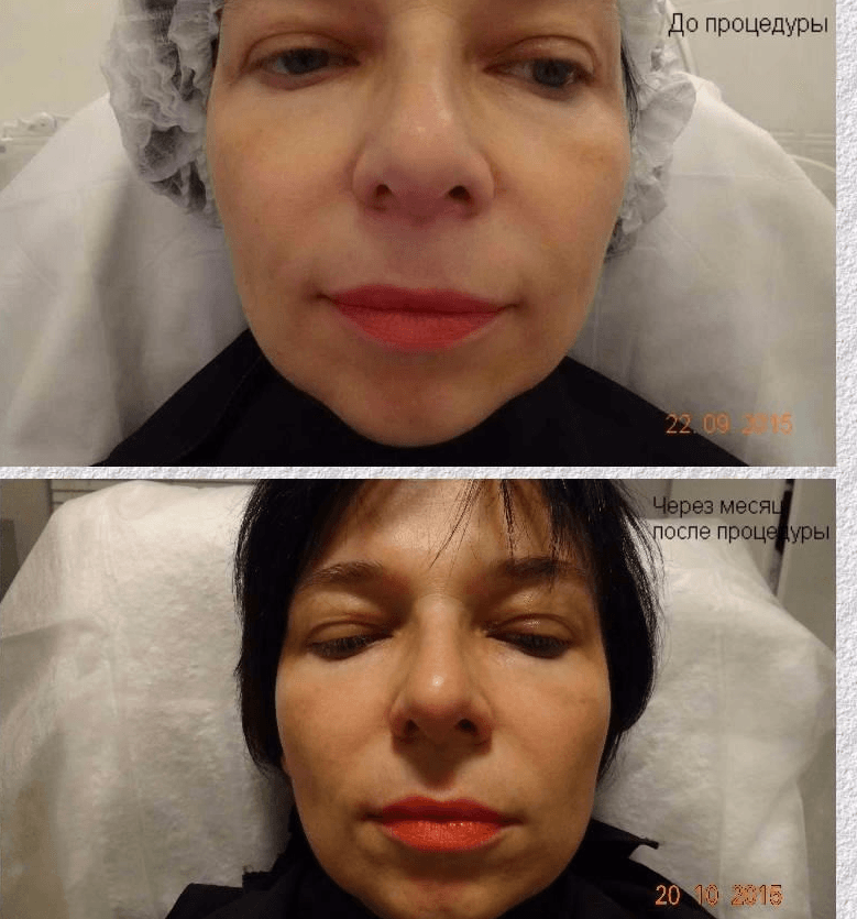 Нити на лицо до и после фото