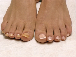 Меры профилактики рецидивов врастания ногтей на ногах