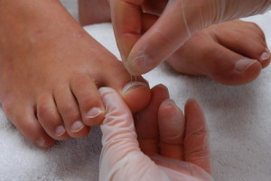 Методы лечения и реабилитационный период при врастании ногтя