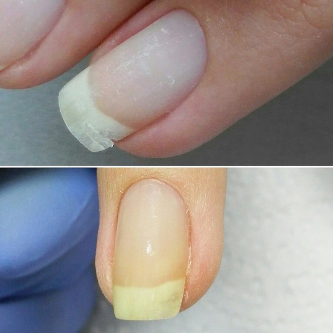 Удлинить пластину. Наращивание на поврежденные ногти. Расширение ногтевой пластины. Наращивание ногтей с удлинением ногтевой пластины.