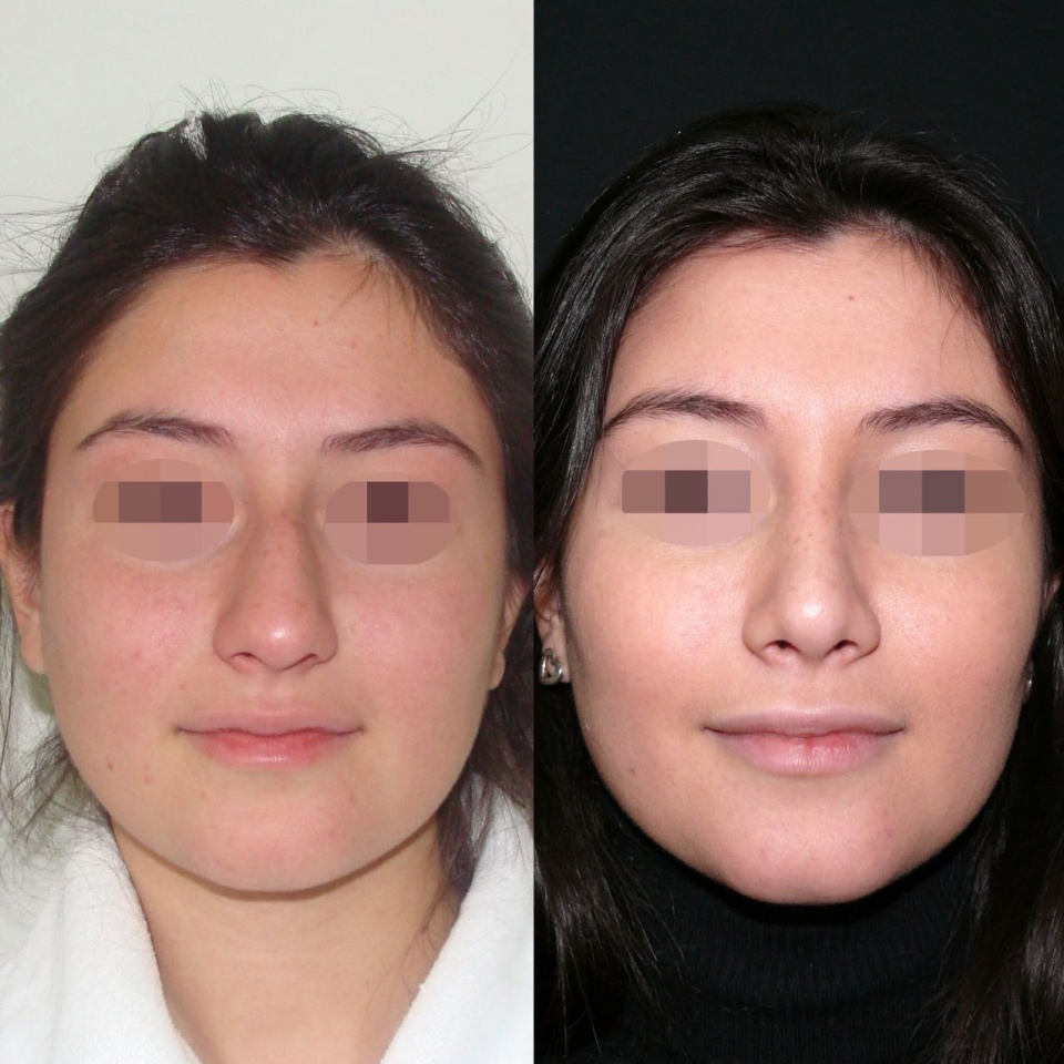 Ринопластика фото до и после нос картошкой ринопластика