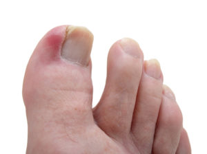 Воспаление на пальце из-за вросшего ногтя