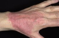 Фотография, как выглядит атопический дерматит на руках