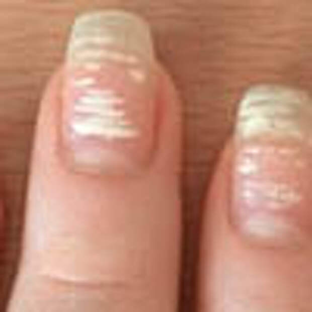 Что означают белые пятна на ногтях рук. Белые пятна на ногтях причины.