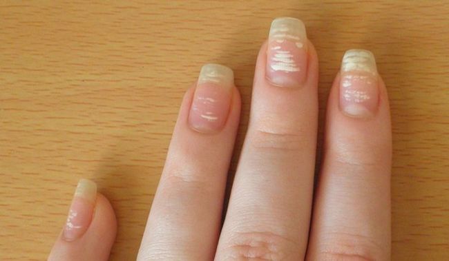 Белые пятна на ногтях - это не косметический дефект, а заболевание