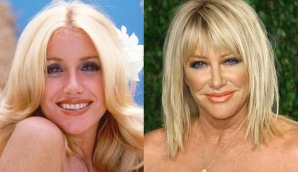 Suzanne Somers before and after plastic surgery photos