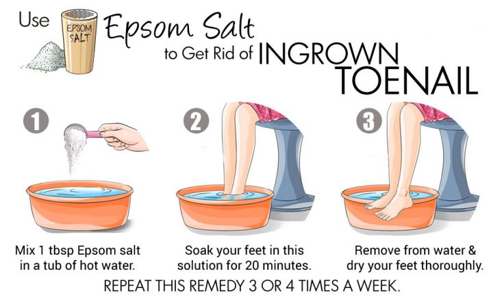 Get Rid Of Ingrown Toenail With Epsom Salt