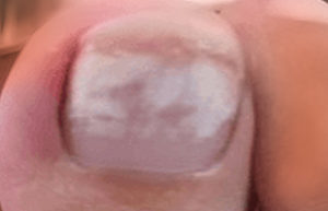 White Spots & White Marks From Toenail Polish