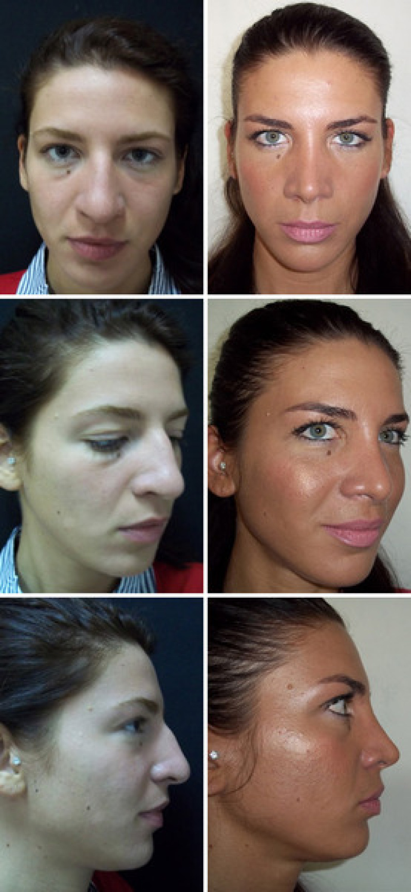 Фото ринопластики до и после нос