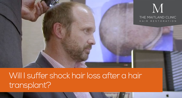 shock loss after hair transplant